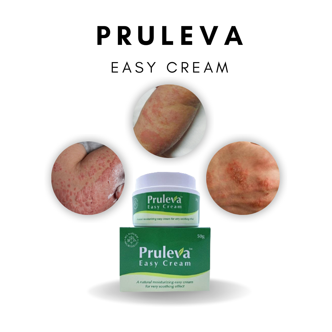 Pruleva Cream: The Ultimate Solution to Eczema Rash and Eczema Disease